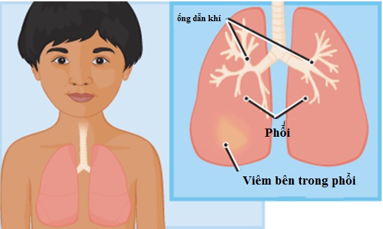 5-yeu-to-nguy-co-gay-viem-phe-quan-cap-o-tre-em-1