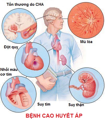 Bệnh huyết áp cao không điều trị kịp thời sẽ gây ra những biến chứng nguy hiểm