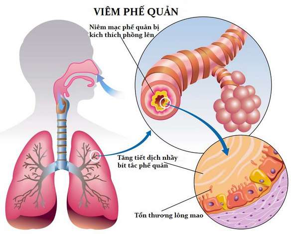 Nguy hiểm với các triệu chứng bệnh viêm phế quản cấp tính