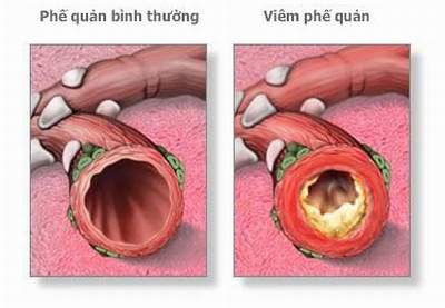 day-lui-viem-phe-quan-o-nguoi-lon-khong-can-khang-sinh-1