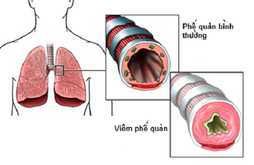 Triệu chứng nhận biết bệnh viêm phế quản