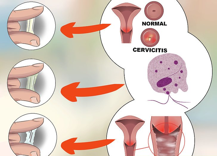 Cảnh báo mắc bệnh viêm phần phụ do khí hư bất thường