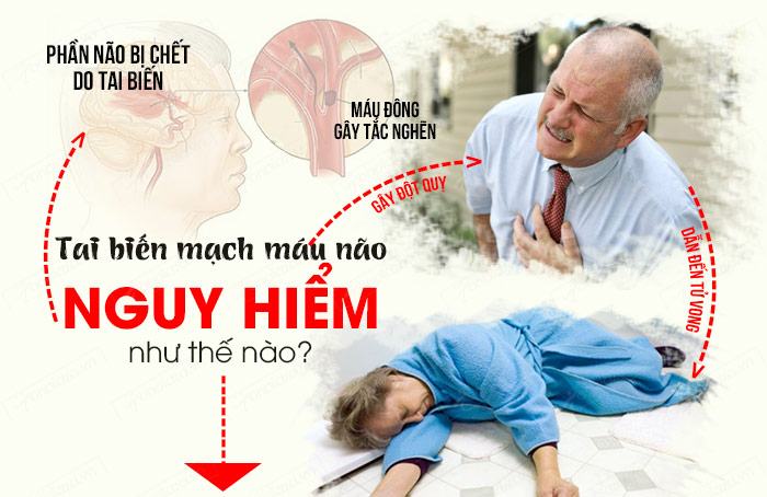 Đột quỵ - tai biến mạch máu não: bệnh lý mạch máu não nguy hiểm nhất