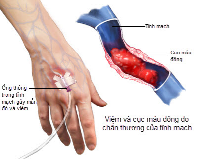 trieu-chung-benh-viem-tac-tinh-mach