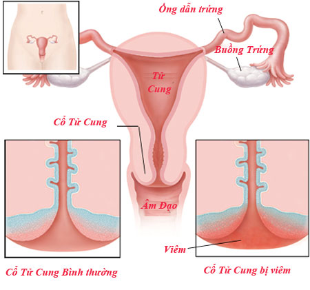 Viêm phần phụ là hiện tượng các loại virus, kí sinh trùng, nấm xâm nhập bộ phận sinh dục phái nữ