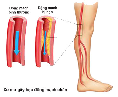 Bệnh viêm tắc tĩnh mạch là bệnh thuộc hệ thống thần kinh- mạch máu vô cùng nguy hiểm