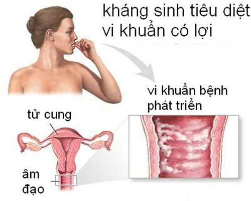 Chỉ dùng thuốc kháng sinh có chữa dứt điểm bệnh viêm phần phụ?